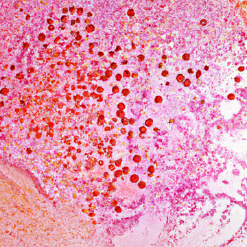 1) The Role of Skin Microbiome in Acne Development: Exploring the Connection Between Bacterial Imbalance and Breakouts